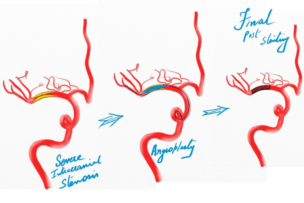 intracranial angioplasty and stenting