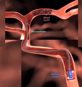 mechanical thrombectomy